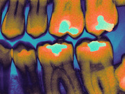 Colorized editorial illustration of dental X-ray showing teeth with highlighted cavity areas in teal and orange hues.